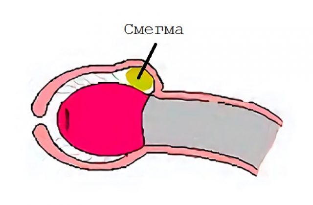 Как открывать головку мальчику видео: Гигиена мальчиков: советы уролога