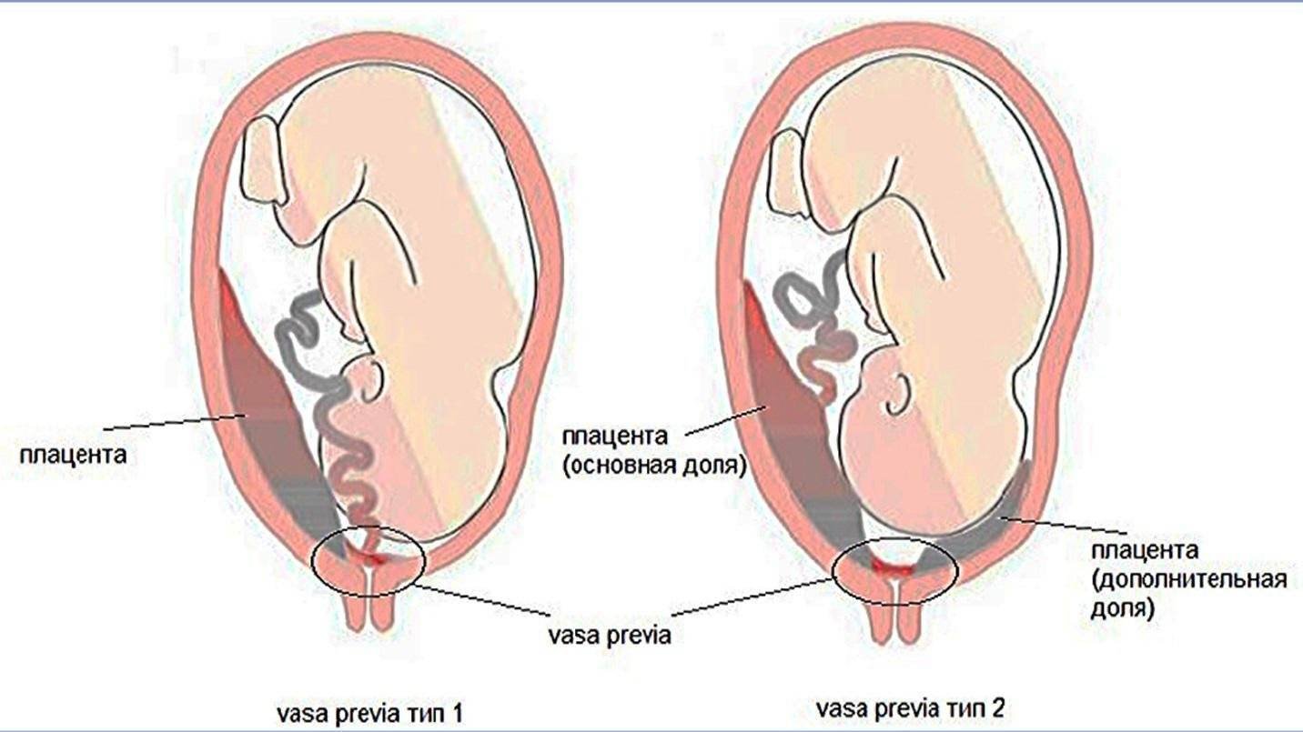 Низкая плацентация при беременности 21 неделя: причины, риски и рекомендации