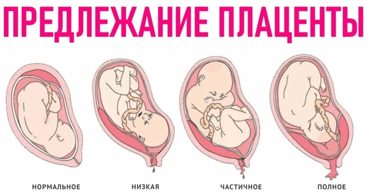 Низкая плацентация при беременности 21 неделя: причины, риски и рекомендации