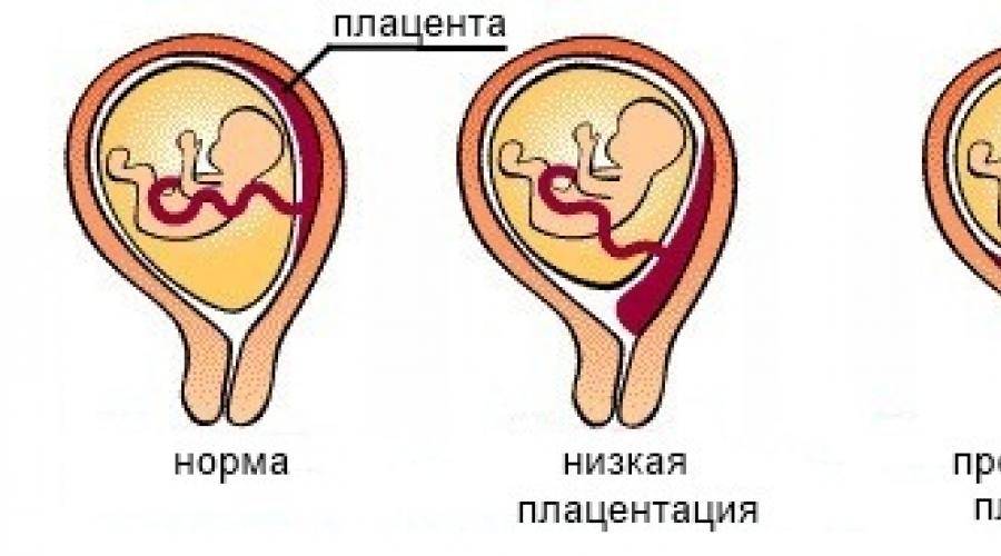 Низкая плацентация при беременности 21 неделя: причины, риски и рекомендации