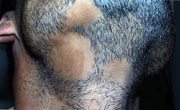 Выпадение волос в бороде: причины выпадения волос и что с этим делать