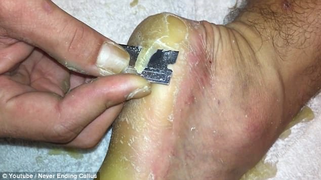 The 20-minute clip shows the man slicing away through the callus on his foot
