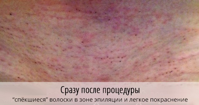 Зуд и жжение после бритья: Раздражение после бритья в интимной зоне: причины, методы избавления, профилактика.