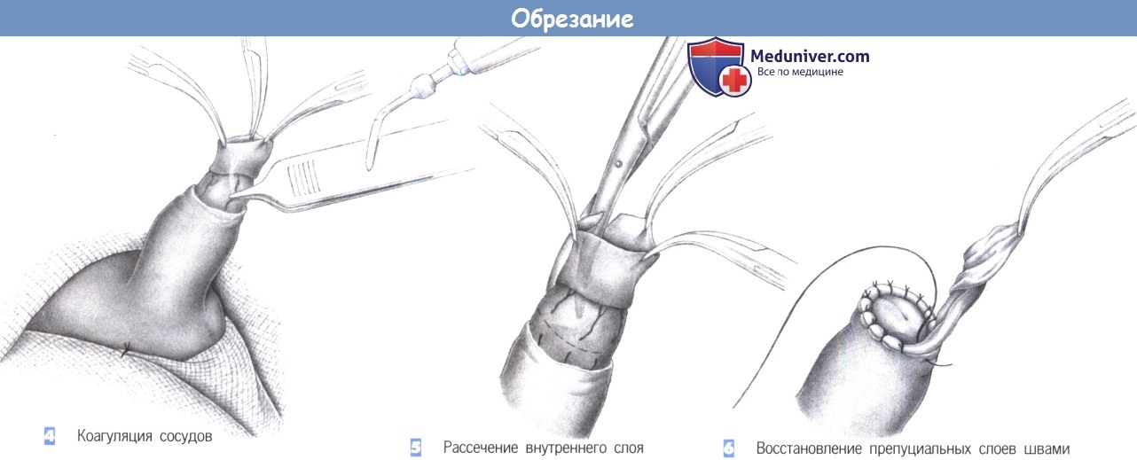 Когда откроется головка у мальчиков: врач-хирург, сосудистый хирург, заслуженный врач РТ Глякин Владимир Яковлевич.