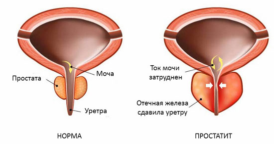 простатит