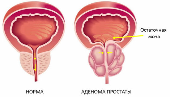 аденома простаты