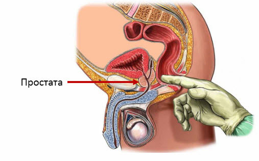 ректальное исследование простаты