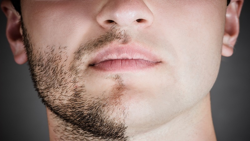 Что делать если растут усы: Усы и способы избавиться от усов: от эпиляции до лазера
