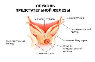 Опухоль в простате