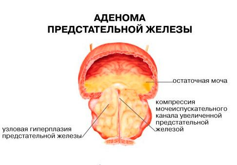 Аденома