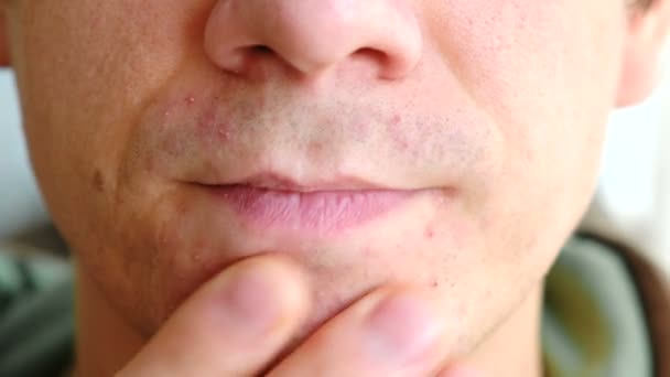 После бритья раздражение на шее: Раздражение после бритья: как избавиться и избежать