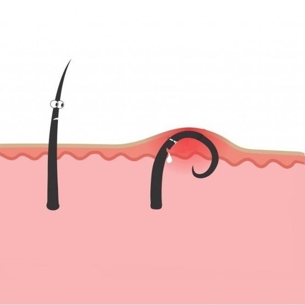 Вросший волос после бритья: Как избавиться от вросших волос