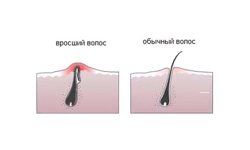 Вросший волос после бритья: Как избавиться от вросших волос