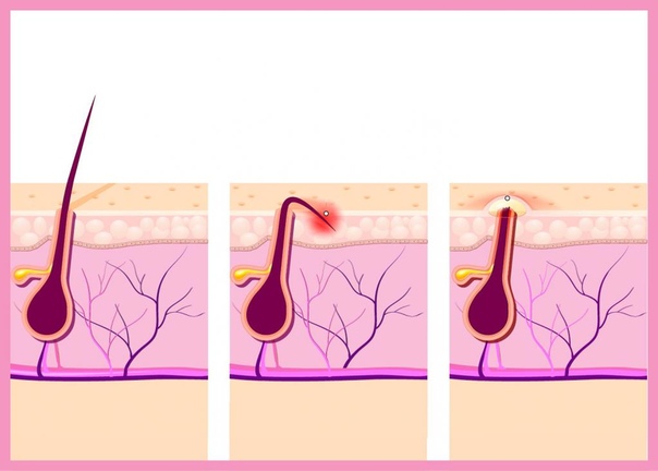 Вросший волос после бритья: Как избавиться от вросших волос