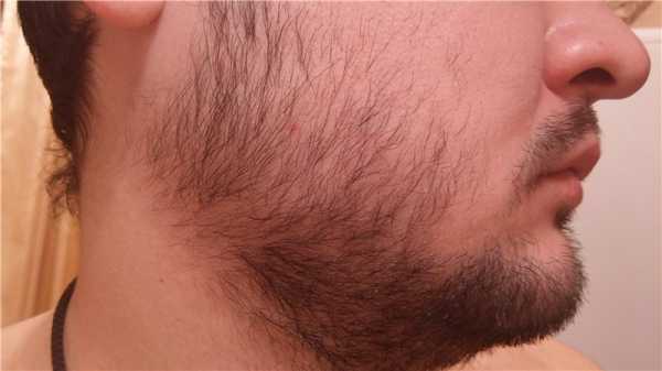 Алерана или генеролон что лучше для бороды – Какой миноксидил лучше - рейтинг препаратов
