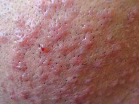 Аллергия после бритья – Аллергическая реакция после бритья: причины, симптомы и что делать