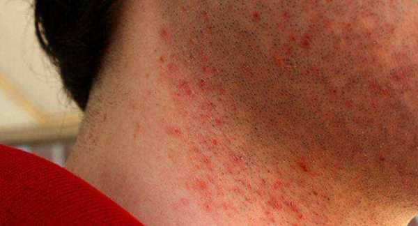 Аллергия после бритья – Аллергическая реакция после бритья: причины, симптомы и что делать