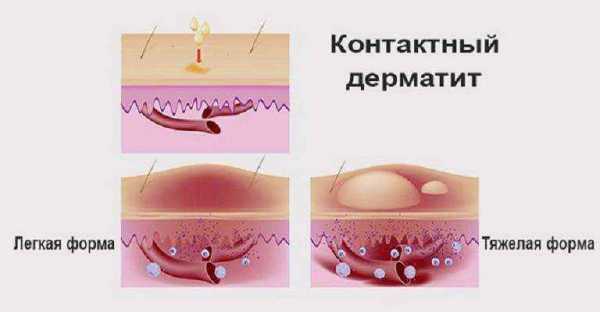 Аллергия после бритья – Аллергическая реакция после бритья: причины, симптомы и что делать