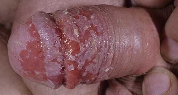 Болезни крайней плоти у мужчин в картинках – фото, кожные, инфекции, заболевания, головки, пениса, болячки, у мужчин, симптомы, лечение