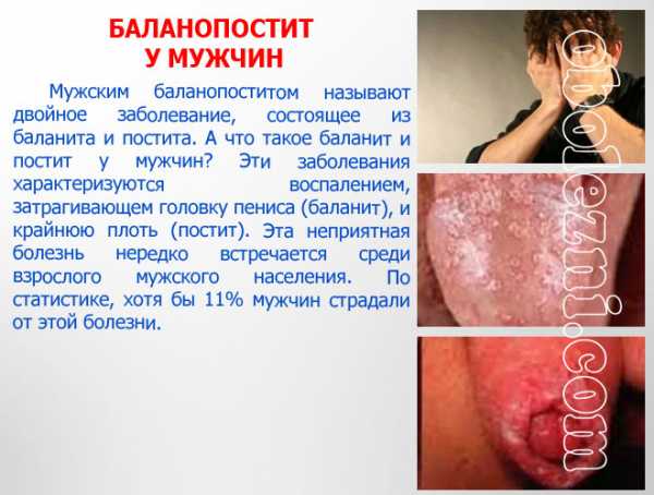 Болезни крайней плоти у мужчин в картинках – фото, кожные, инфекции, заболевания, головки, пениса, болячки, у мужчин, симптомы, лечение