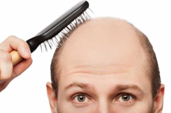 Диффузное облысение у мужчин – Диффузная алопеция: выпадение волос у мужчин