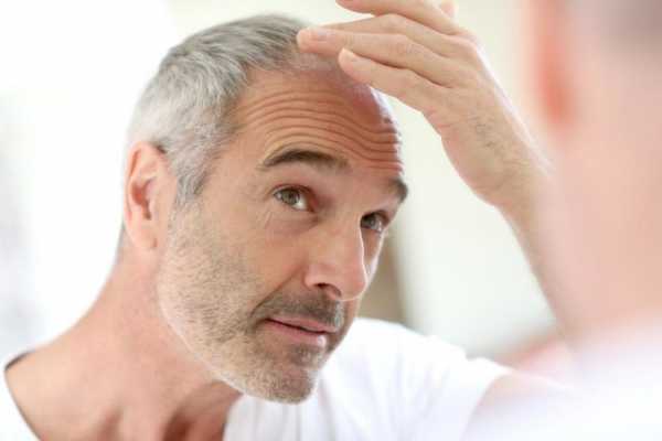 Диффузное облысение у мужчин – Диффузная алопеция: выпадение волос у мужчин