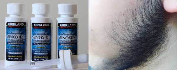 Для роста бороды minoxidil – инструкция по использованию, состав препарата, его действие.