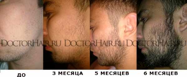 Для роста бороды minoxidil – инструкция по использованию, состав препарата, его действие.