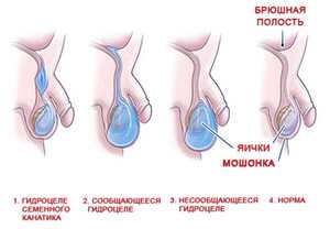 Если у мужчины одно яичко больше другого что это значит – причины увеличения правого или левого