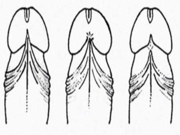 Где уздечка на головке – Где находится уздечка у мужчин: анатомия и функции