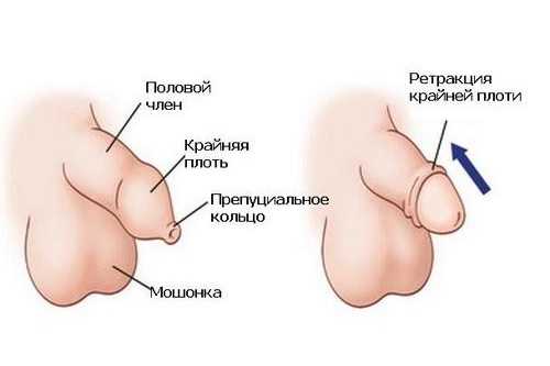 Как должен открываться головка у мальчиков фото – лечение в домашних условиях, до и после операции, физиологическая и рубцовая форма у грудничков и новорожденных