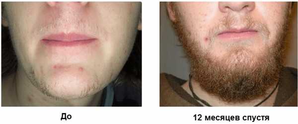 Миноксидил помогает ли для роста бороды – Как правильно пользоваться Миноксидилом для бороды и помогает ли он? Какая форма этого препарата лучше всего?