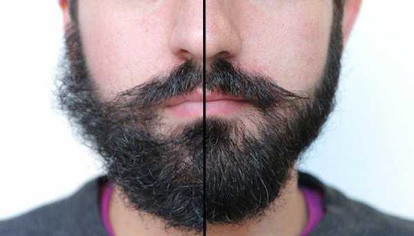 Не растут волосы на щеках у мужчин – у мужчины на щеках, подбородке и усы, почему местами, плохо или медленно, как отрасти или вырастить, что делать, а также причины