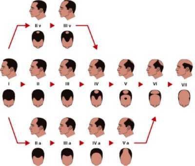 Облысения степени – Степени облысения у мужчин и женщин по классификации Норвуда