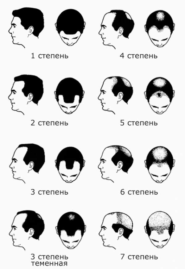 Облысения степени – Степени облысения у мужчин и женщин по классификации Норвуда