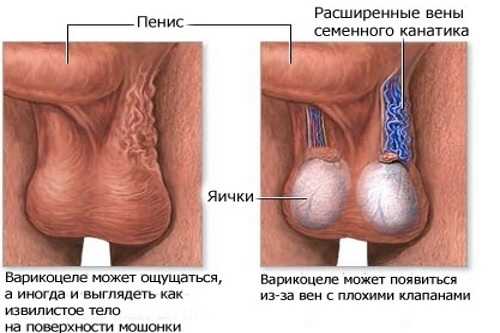 Одно яичко у мужчины почему – Помогите советом, у мужчины ОДНО яичко...