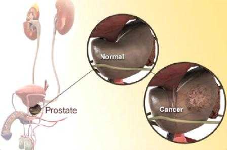 Простаты что это – Что такое простата у мужчин и как она проявляется