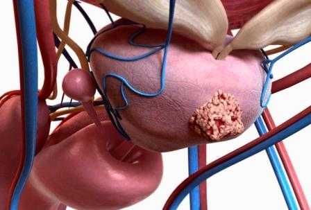 Простаты что это – Что такое простата у мужчин и как она проявляется