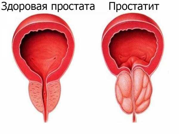 Простаты что это – Что такое простата у мужчин и как она проявляется