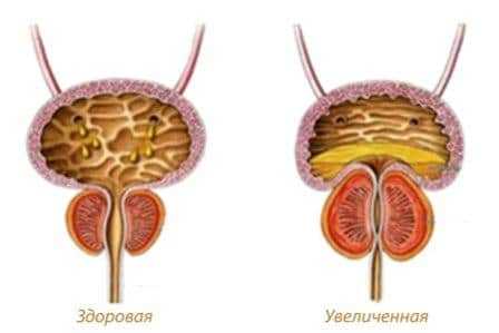 Простаты что это – Что такое простата у мужчин и как она проявляется