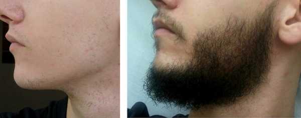 Репейное масло для волос для роста волос на лице – Как использовать репейное масло, чтобы отрастить щетину или бороду