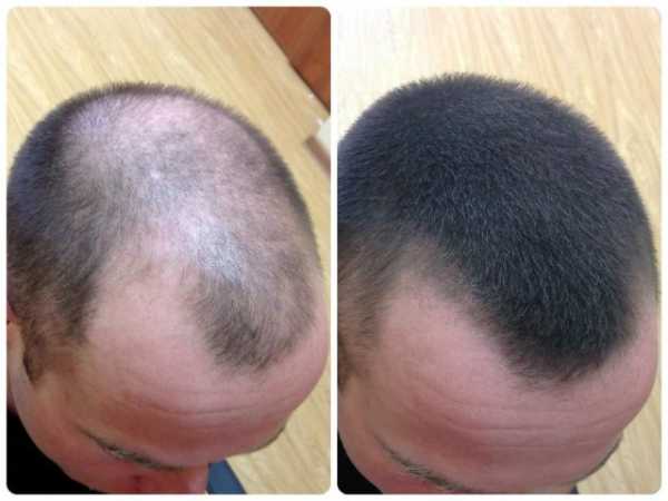 Витамины для роста волос на голове для мужчин – отзывы, инструкция по применению, цена, список лучших