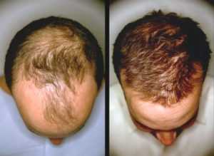 Витамины для волос от выпадения волос для мужчин – отзывы, инструкция по применению, цена, список лучших
