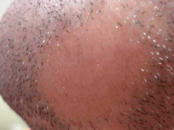 Выпадение волос в бороде – почему выпадают волосы и появляются лысые места, каковы причины возникновения алопеции, а также какие методы лечения облысения сейчас популярны?