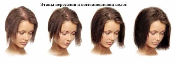Женские прически скрывающие залысины – Парикмахер может убрать залысины в том случае, если